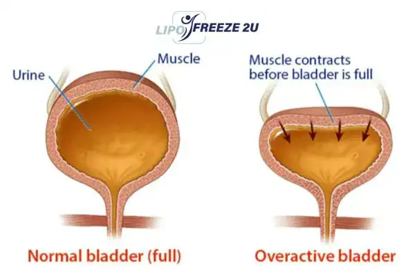 diagram of overactive bladder treatment Elstree