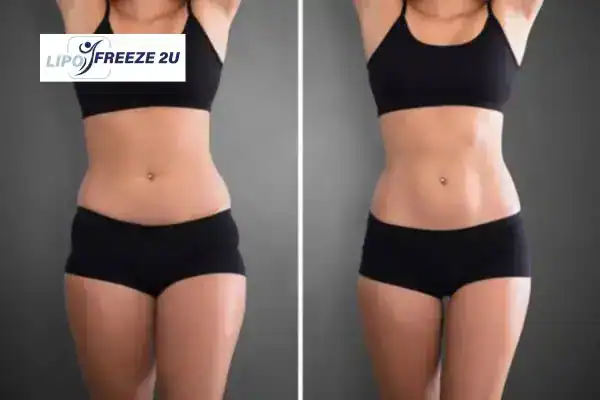 How Can LIPO FREEZE 2U Support Your Post-Pregnancy Body Recovery Elstree?