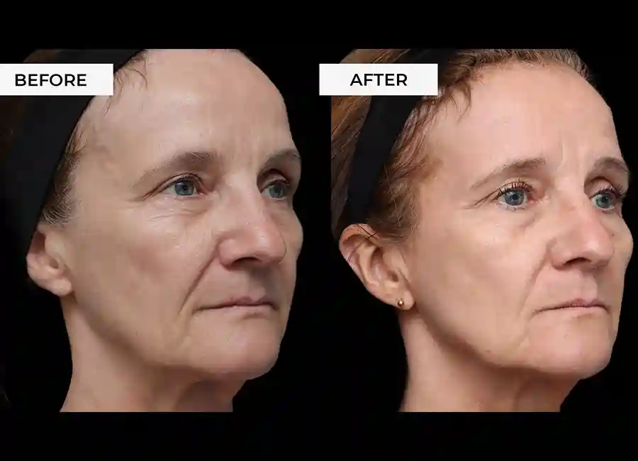 How Many RF Microneedling Sessions Will You Need to See a Difference Elstree?